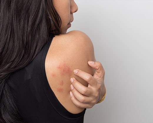 Wyprysk kontaktowy alergiczny