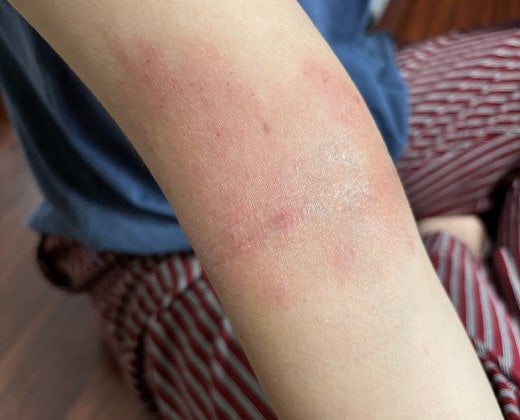 Atopowe zapalenie skóry na ręce u dziecka