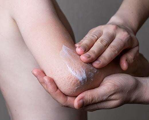 Leczenie atopowego zapalenia skóry i pielęgnacja z kosmetykami La Roche-Posay