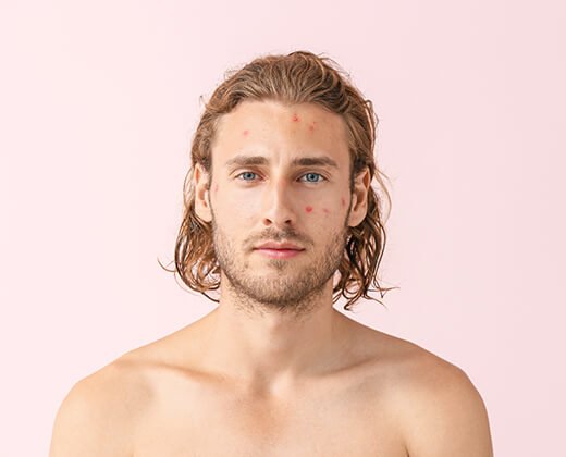 Mężczyzna z krostami na twarzy