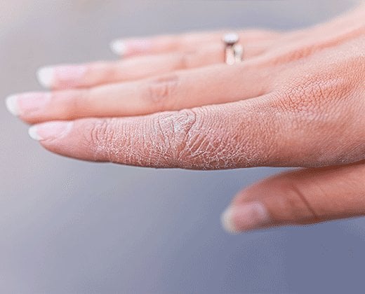 Łuszczenie skóry na dłoniach