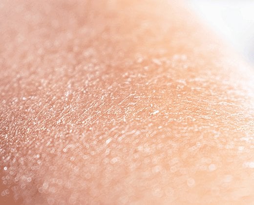 Zbliżenie na łuszczącą się skórę