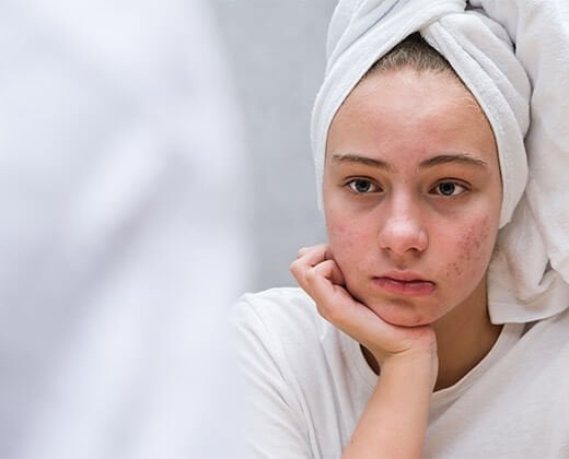 Nastoletnia dziewczyna ze skórą trądzikową