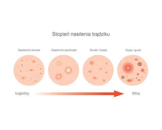 stopień nasilenia trądziku