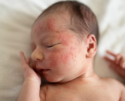 Trądzik niemowlęcy