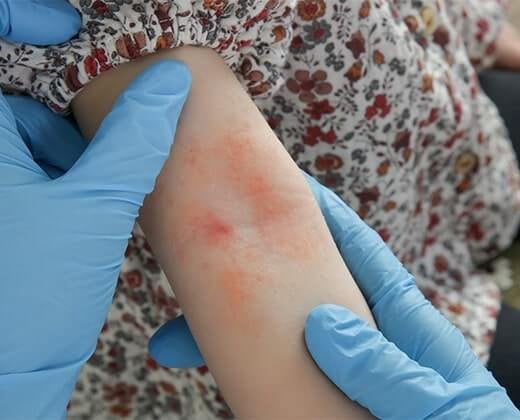 Sprawdź jak wygląda skóra atopowa