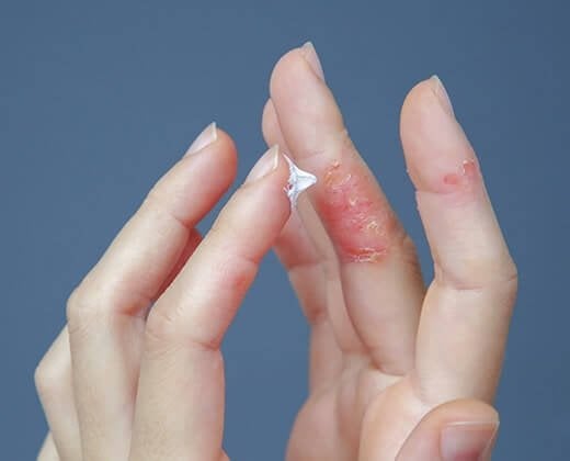 Dłonie ze skórą atopową - poznaj krem do dłoni z atopią La Roche-Posay