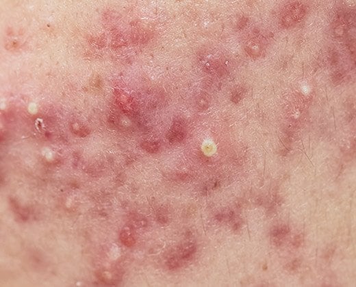 objawy trądziku hormonalnego