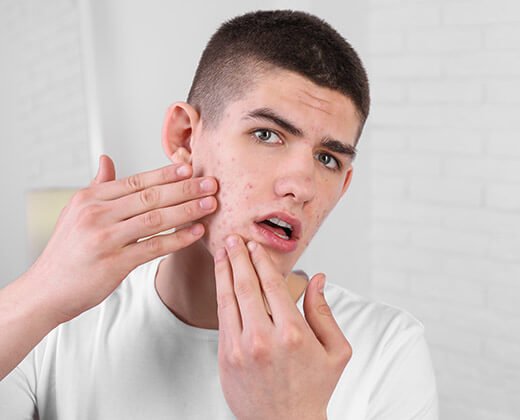 Mężczyzna z trądzikiem hormonalnym