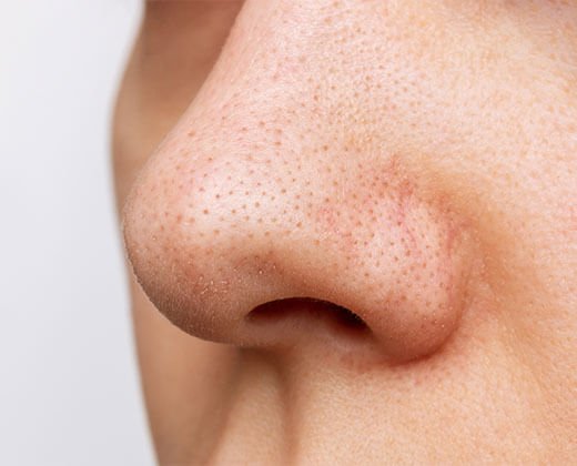 Zatkane pory na nosie