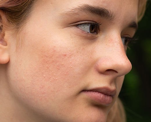 Skóra z zatkanymi porami - jakie wybrać kosmetyki do pielęgnacji?