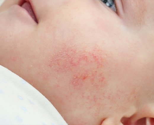 AZS na twarzy niemowlaka