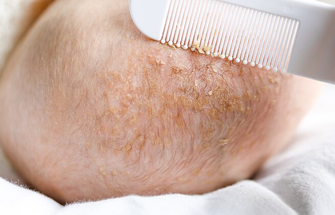 Skóra niemowlaka z ciemieniuchą