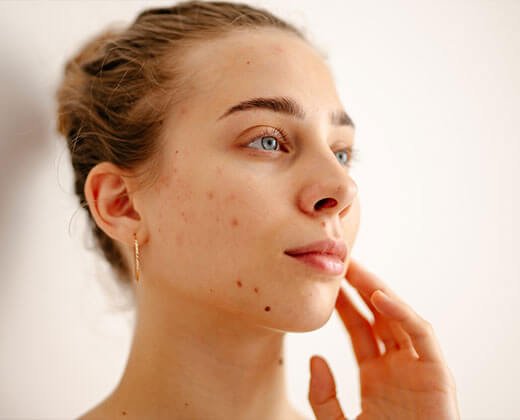 Dieta na trądzik - kobieta o zdrowo wyglądającej cerze dzięki odpowiedniej diecie
