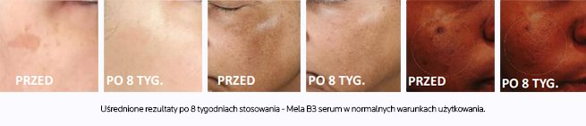 Zdjęcia efektów serum Mela B3 na przebarwienia na każdym fototypie skóry