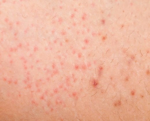 Zbliżenie na skórę z objawami zapalenia okołomieszkowego