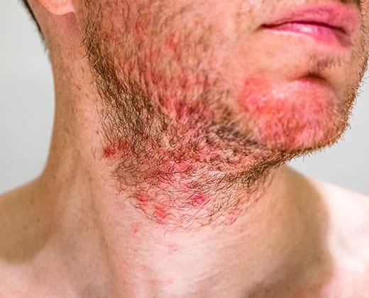 Mężczyzna z zapaleniem mieszków włosowych po goleniu