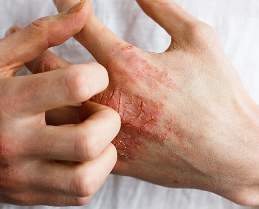 Egzema na dłoniach