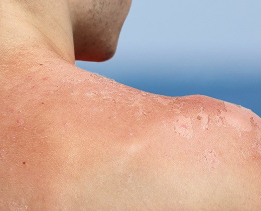 Ramię z oparzeniem słonecznym i schodzącą skórą