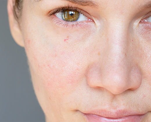 Zaczerwienienia na twarzy jako objaw skóry naczynkowej