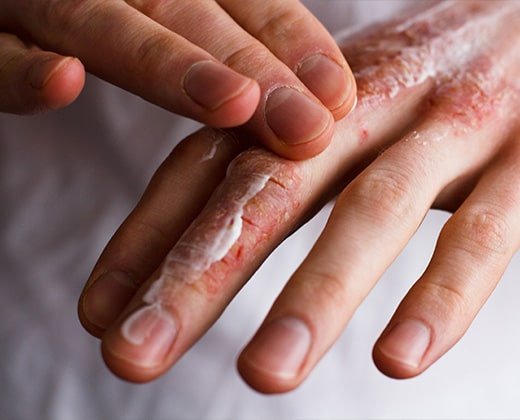 Pękająca skóra na dłoni, na którą nakłada się krem regenerujący
