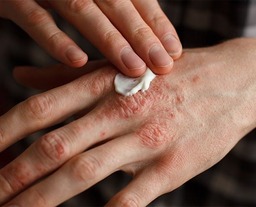Aplikacja kremu na pęknięcia skóry na palcach dłoni