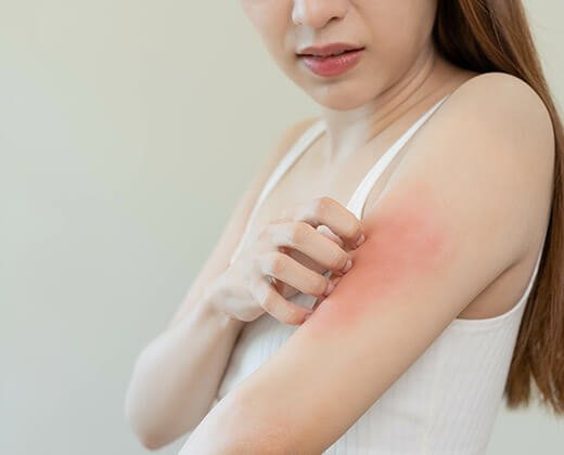 Kobieta z podrażnieniami skóry