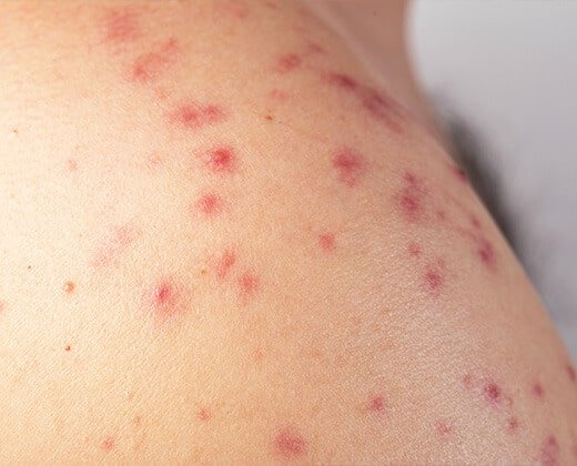 Objawy świerzbiączki na ramionach