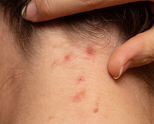 Trądzik na szyi u kobiety